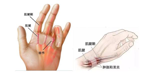 屈指肌腱挛缩图片