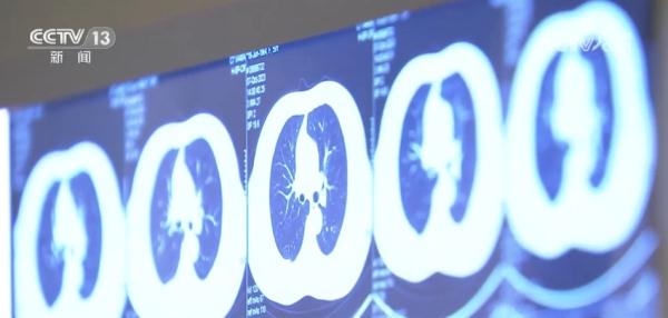 早发现早治疗有效提高肺癌生存率 肺结节你了解吗? 早发现早治疗有效提高肺癌生存率 肺结节你了解吗?