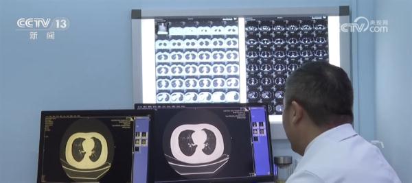 早发现早治疗有效提高肺癌生存率 肺结节你了解吗? 早发现早治疗有效提高肺癌生存率 肺结节你了解吗?