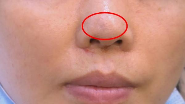 “随时都在恐惧中！”贵阳女子隆鼻术后流脓又流血，索赔15000元