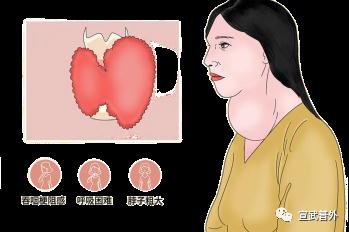 “甲亢”来势汹汹,你的心脏还好吗? “甲亢”来势汹汹,你的心脏还好吗?