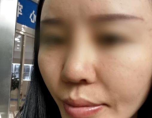 “随时都在恐惧中！”贵阳女子隆鼻术后流脓又流血，索赔15000元