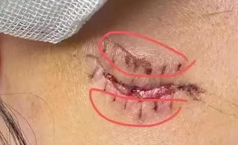 爆了！哈尔滨女孩满脸是血，缝了8针！这种网红饮品很多人在喝…...