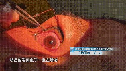 女子双眼取出60多条活虫! 医生:可能接触了有寄生虫的宠物后揉眼睛 女子双眼取出60多条活虫! 医生:可能接触了有寄生虫的宠物后揉眼睛