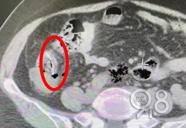 因这习惯，女子小肠严重感染，被迫暂用人工肛门……