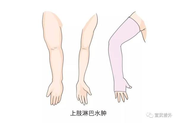 如何识别淋巴水肿早期征兆？