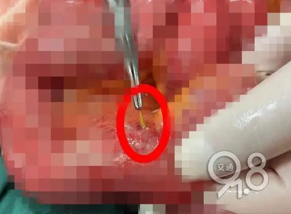 因这习惯，女子小肠严重感染，很多人却还在这么做