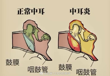 耳痛又发热 当心是急性中耳炎 耳痛又发热 当心是急性中耳炎