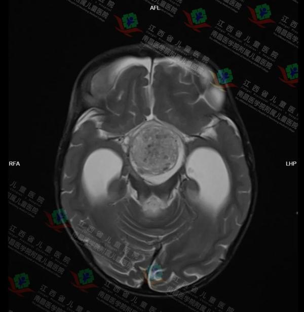 江西3岁女童突然神志不清、四肢抽搐！检查后发现……