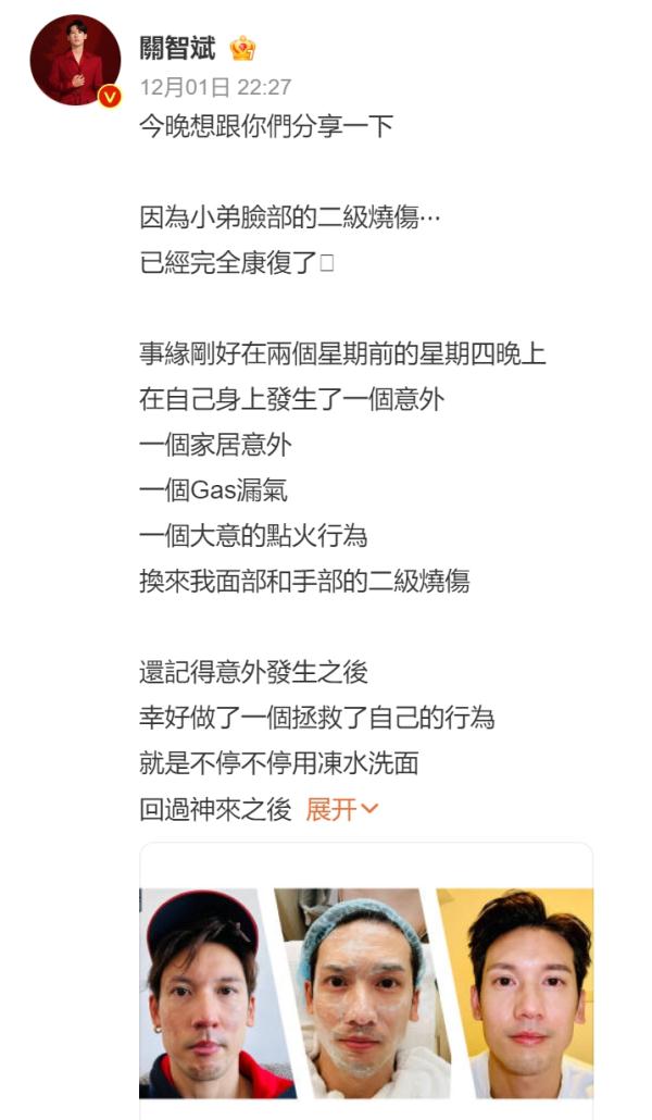 演员关智斌自曝煤气意外泄漏致面部手部二级烧伤