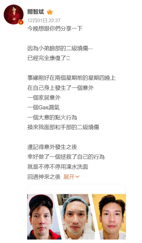 知名男星自曝脸部二级烧伤，紧急提醒→
