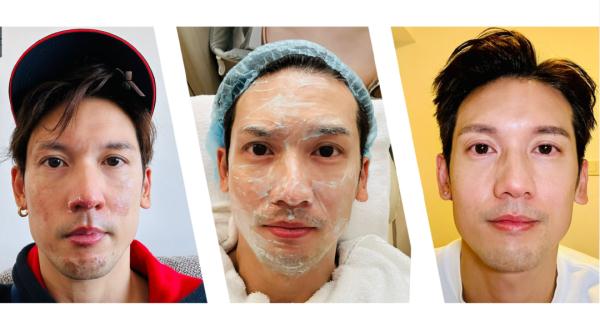 知名男星自曝脸部二级烧伤，紧急提醒→