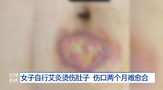 女子肚子上被烫出两个水泡,伤口难愈合,医生提醒:冬季多发要谨防 女子肚子上被烫出两个水泡,伤口难愈合,医生提醒:冬季多发要谨防