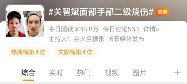 男演员面部、手部二级烧伤!医生提醒! 男演员面部、手部二级烧伤!医生提醒!