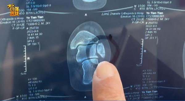 杭州小伙骨折去医院,2次都没查出来?! 杭州小伙骨折去医院,2次都没查出来?!