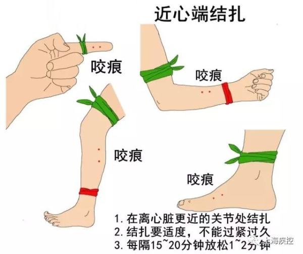 女子称入住上海网红酒店被蛇咬，商家最新回应！被毒蛇咬了该怎么办？
