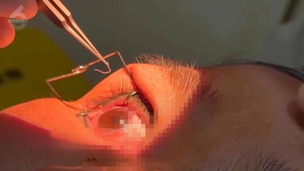 女子双眼取出60多条活虫，很多人都有这个习惯