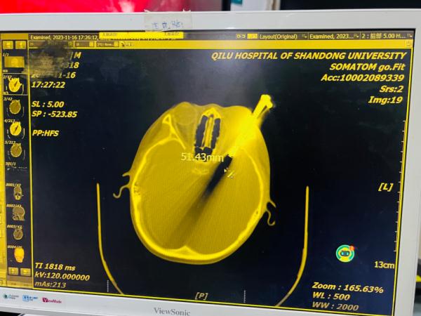 男孩放学路上摔一跤，钥匙插入眼眶！医生紧急提醒