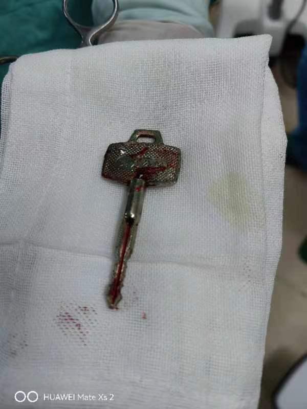 男孩放学路上摔一跤，钥匙插入眼眶！医生紧急提醒