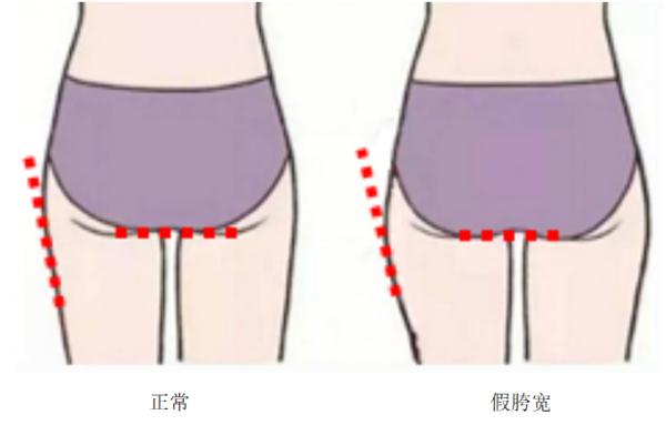 “臀塌腿粗”?可能是“假胯宽”惹的祸 “臀塌腿粗”?可能是“假胯宽”惹的祸