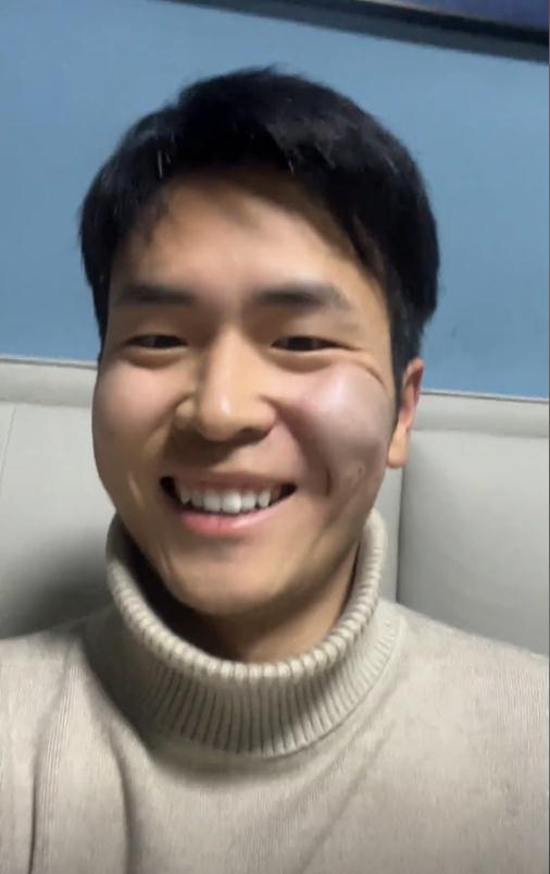 小伙猪肉印章盖脸上，时隔五天终于洗掉，称：不要模仿