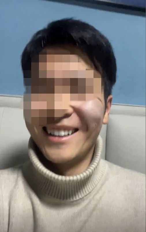 小伙脸上被盖猪肉印章，时隔五天终于洗掉，但是……