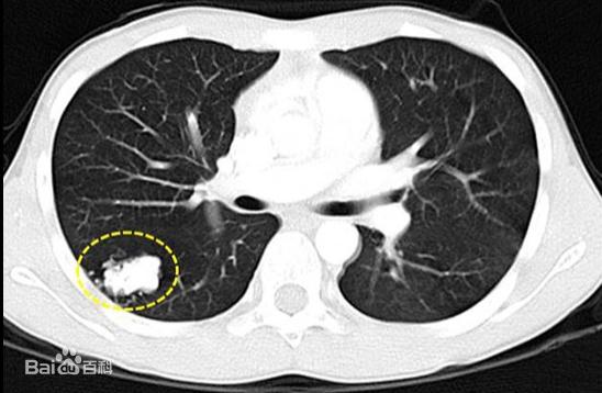 杭州女子难以接受：才29岁，怎么就癌症晚期了……