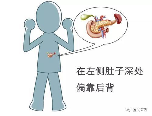 这些症状是胰腺炎前兆?你中招了么 这些症状是胰腺炎前兆?你中招了么