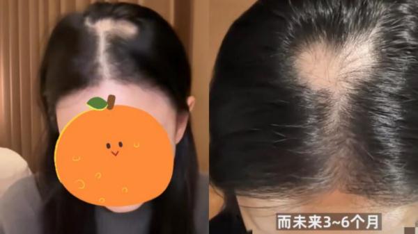 追求“高颅顶”注射50来支玻尿酸，百万粉丝女网红变成“鬼剃头” 