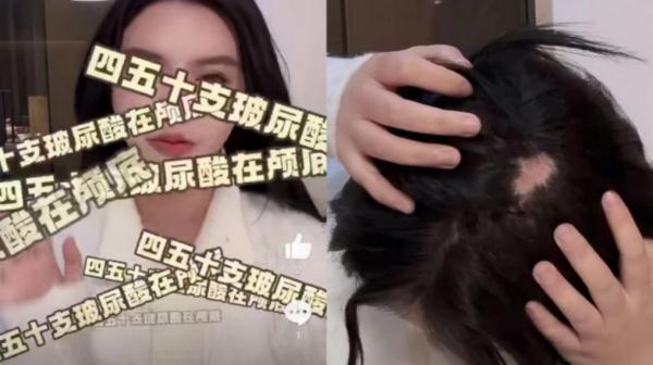追求“高颅顶”注射50来支玻尿酸，百万粉丝女网红变成“鬼剃头” 