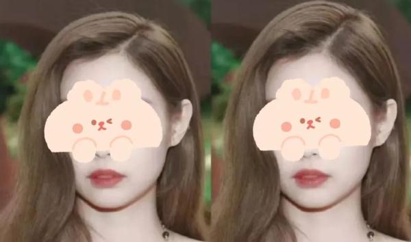 追求“高颅顶”注射50来支玻尿酸，百万粉丝女网红变成“鬼剃头” 