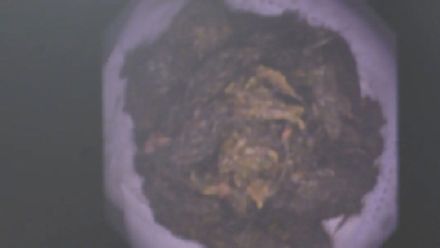 9岁女孩患“长发公主综合征”,胃里取出直径8厘米巨大结石 9岁女孩患“长发公主综合征”,胃里取出直径8厘米巨大结石