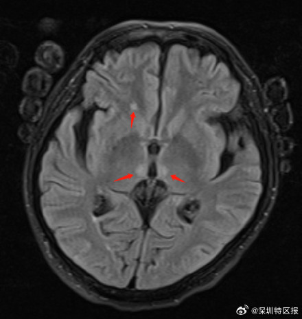 50岁男子因酗酒突然瘫痪进ICU躺了130天 50岁男子因酗酒突然瘫痪进ICU躺了130天