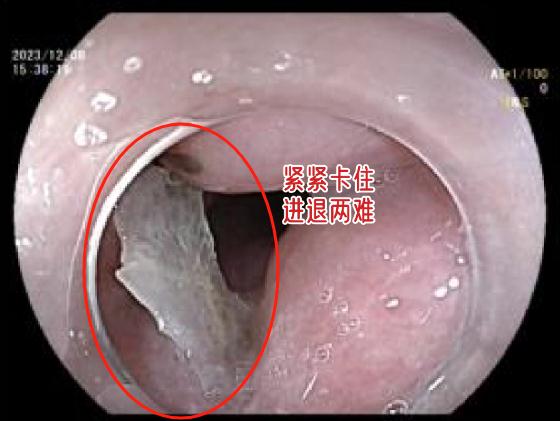 六旬阿姨命悬一线,医生用一个避孕套救了她! 六旬阿姨命悬一线,医生用一个避孕套救了她!