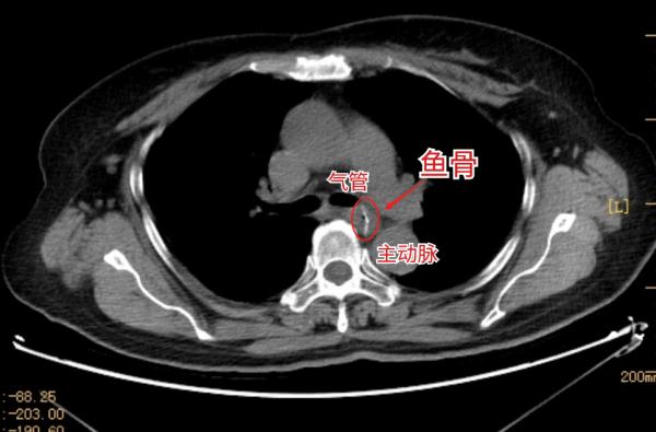 最要命的是,魚骨毗鄰左側支氣管,肺動脈和主動脈.