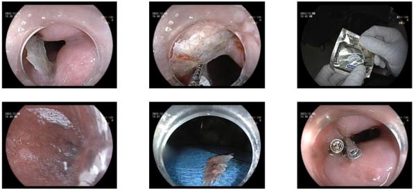 六旬阿姨命悬一线,医生用一个避孕套救了她! 六旬阿姨命悬一线,医生用一个避孕套救了她!