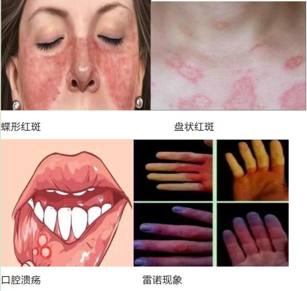 这种“不死的癌症”尤其偏爱女性