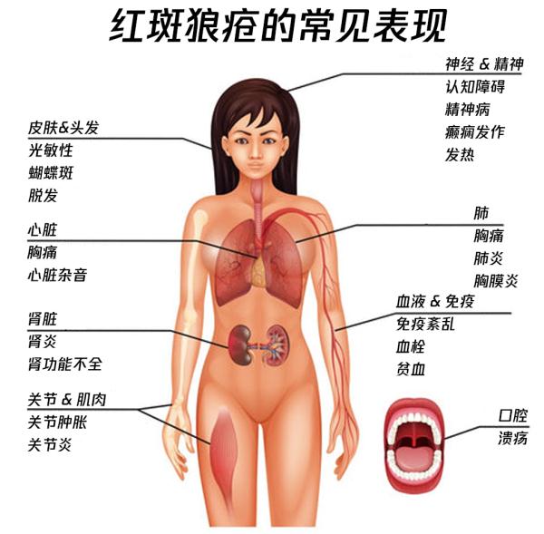 这种“不死的癌症”尤其偏爱女性