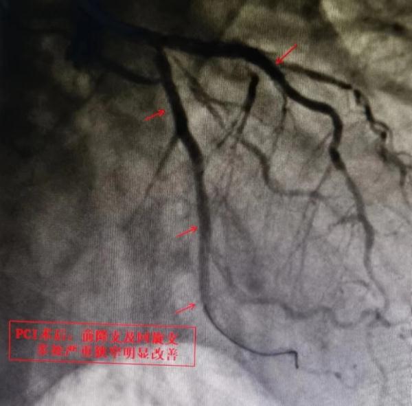 大爷打嗝嗳气长达半年，竟与胃病无关？警惕症状不典型的冠心病
