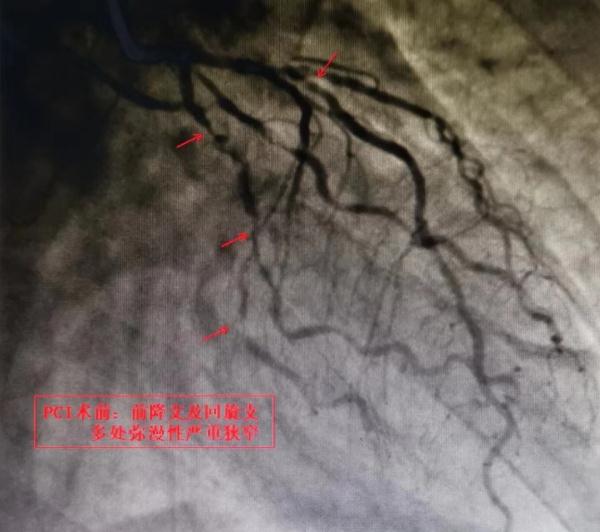 大爷打嗝嗳气长达半年，竟与胃病无关？警惕症状不典型的冠心病