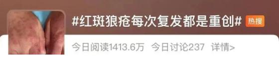 “红斑狼疮”冲上热搜!医生发出提醒 “红斑狼疮”冲上热搜!医生发出提醒