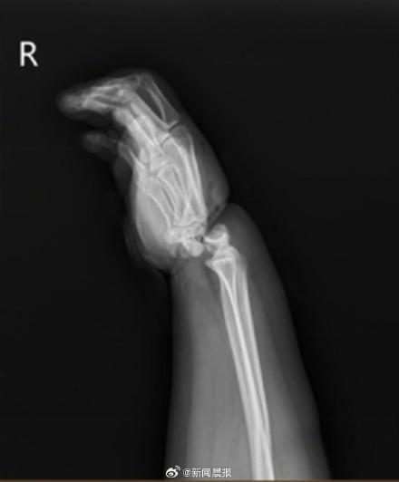 女子拔河手腕被绞断