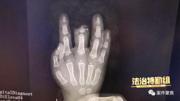 事发上海,19月龄女童被扶梯夹断手指!监护人将商场告上法庭,判了 事发上海,19月龄女童被扶梯夹断手指!监护人将商场告上法庭,判了