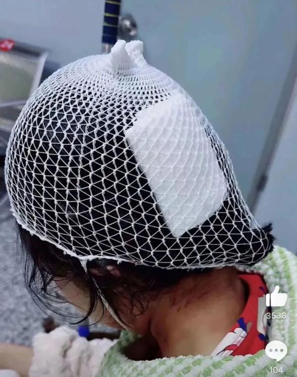 车祸时鲨鱼夹插进女子后脑头皮,警惕氛围感“神器”伤人 车祸时鲨鱼夹插进女子后脑头皮,警惕氛围感“神器”伤人