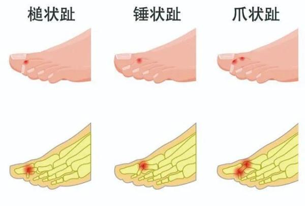脚长歪了是脚的错吗？也可能是穿鞋穿出来的