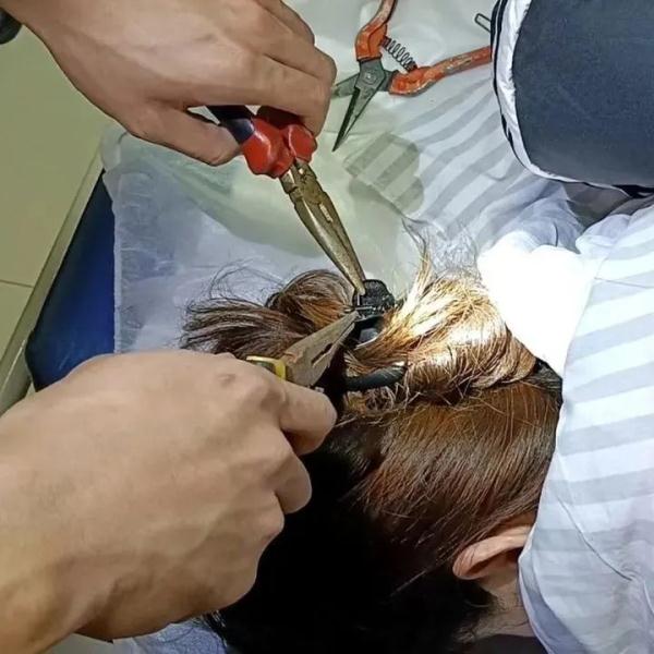 车祸时鲨鱼夹插进女子后脑头皮,警惕氛围感“神器”伤人 车祸时鲨鱼夹插进女子后脑头皮,警惕氛围感“神器”伤人