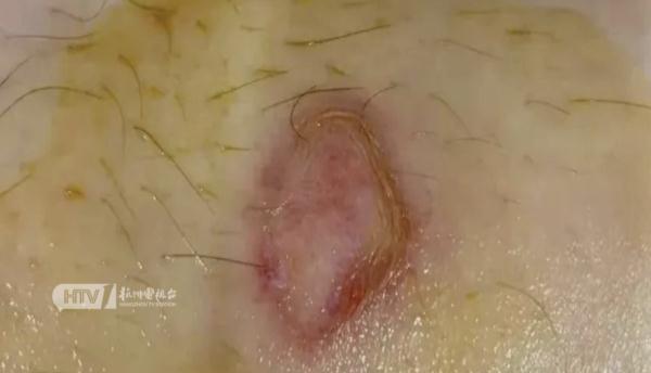 一觉醒来莫名红斑？医生提醒：近期高发！