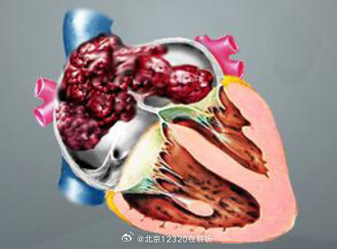 心脏长肿瘤可能与哪些因素有关? 心脏长肿瘤可能与哪些因素有关?