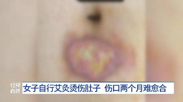 女子被烫出水泡，伤口两个月难愈合！气温下降，小心低温烫伤→