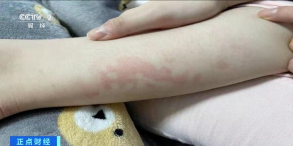 冬季警惕发生低温烫伤!医生提醒:不要通宵使用电热毯 冬季警惕发生低温烫伤!医生提醒:不要通宵使用电热毯